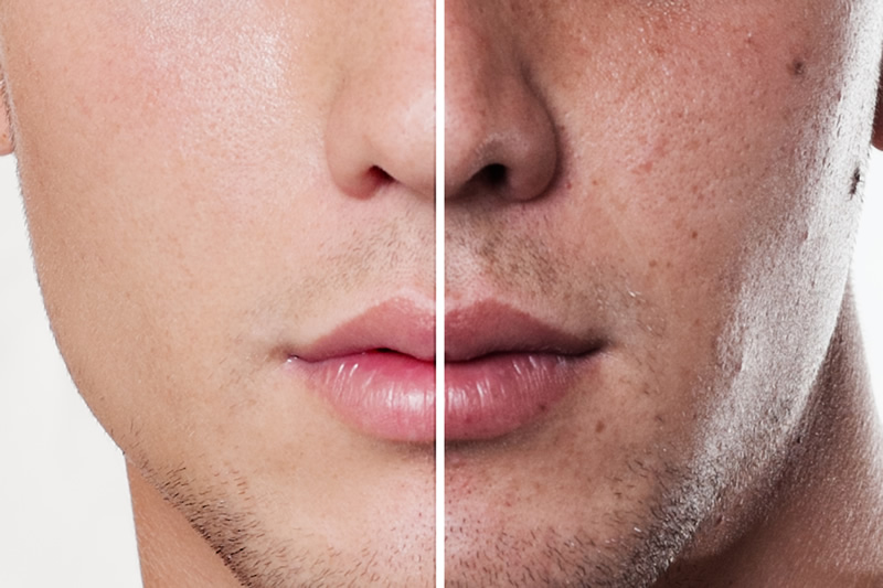 Laser Facial Resurfacing