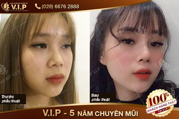 khách hàng nâng mũi tại Nâng mũi VIP