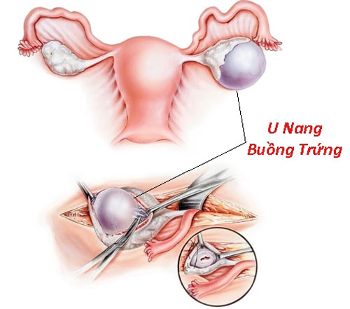 Cắt bỏ u nang buồng trứng