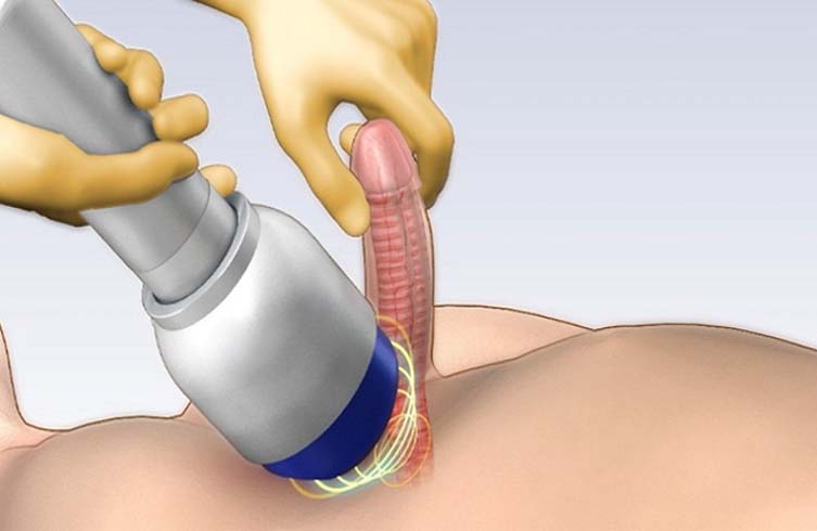 điều trị bệnh liệt dương