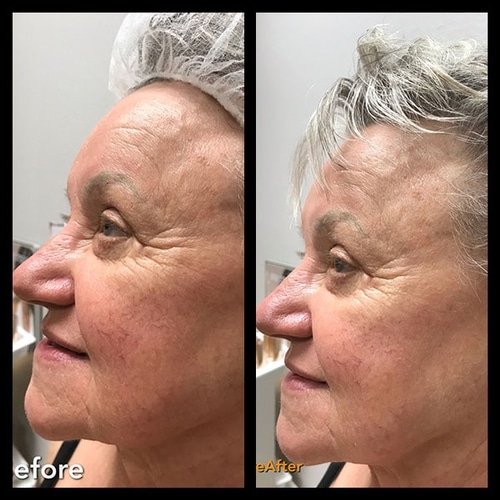 Neurotris Microcurrent Facial Sculpting Sarasota Skincare Couture