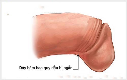 Rách dây thắng bao quy đầu phải làm sao chữa