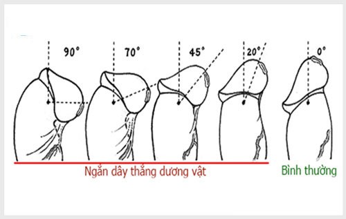 Rách dây thắng bao quy đầu phải làm sao chữa
