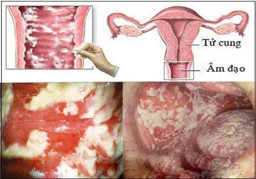 Khí hư ra màu xanh nhạt đặc vón cục như bã đậu là bệnh gì?
