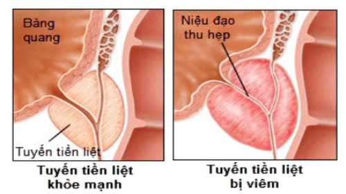 Nguyên nhân do mắc tình trạng bệnh viêm tuyến tiền liệt