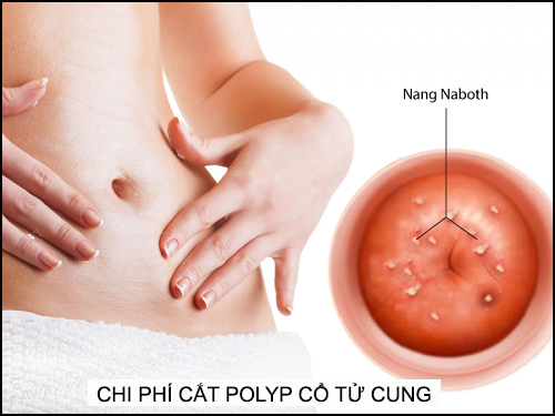 Chi phí phẫu thuật cắt polyp cổ tử cung hết bao nhiêu tiền