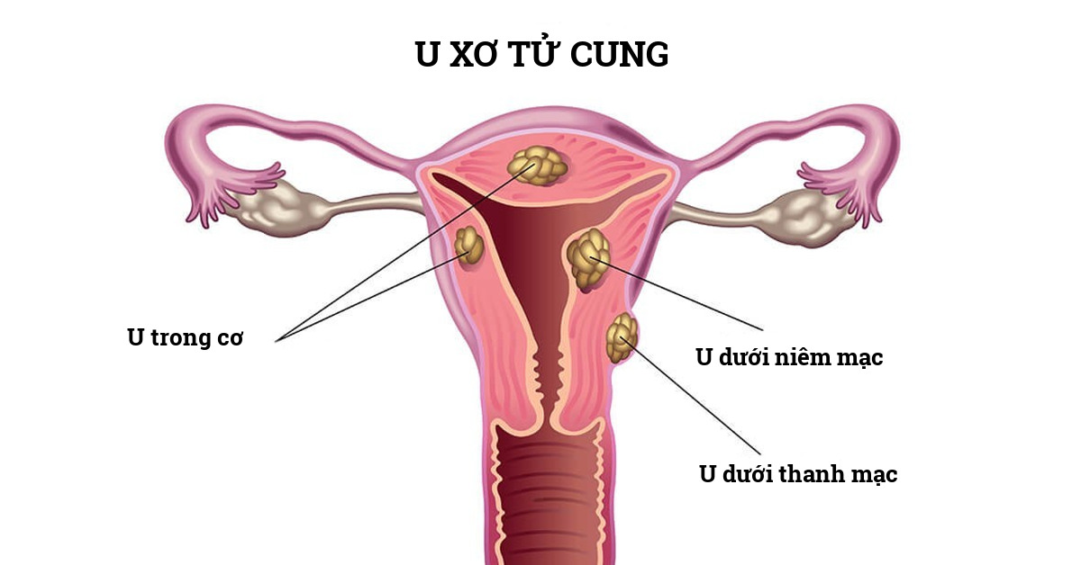 Điều trị bệnh u xơ tử cung ở đâu hiệu quả nhất tại TPHCM