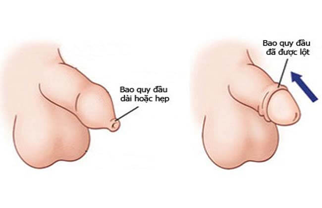 tại sao nên cắt bao quy đầu