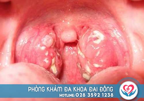 Hình ảnh viêm họng hạt ở người lớn và trẻ em