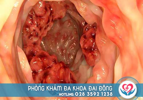 Nguyên nhân đi cầu ra máu là gì
