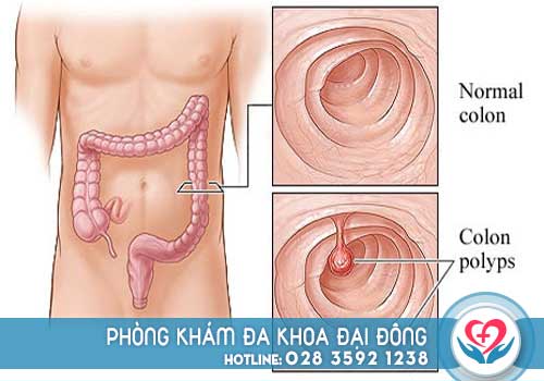 Chi phí cắt polyp hậu môn bao nhiêu tiền