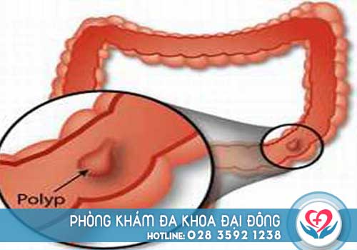 Chi phí cắt polyp hậu môn là bao nhiêu