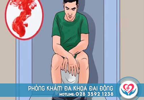 Đi cầu ra máu ở nam giới