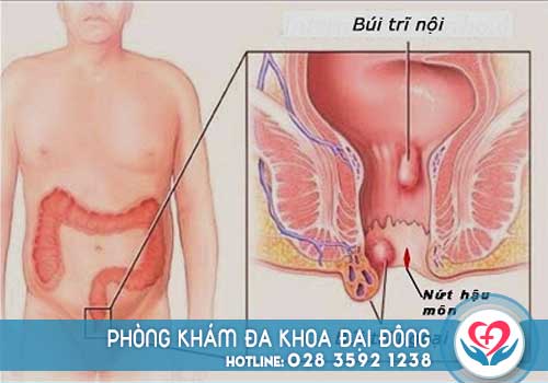 Đi cầu ra máu ở nam giới