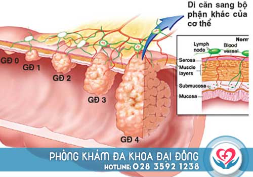 Hình ảnh polyp hậu môn ở nam giới và phụ nữ