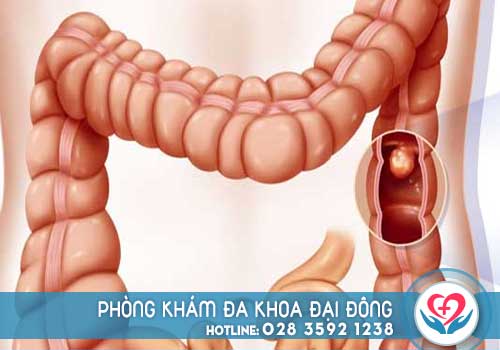 Polyp hậu môn là bệnh gì, nguyên nhân