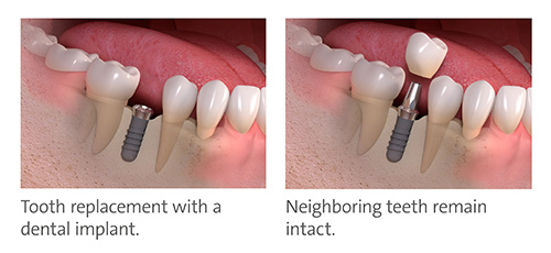 MYTHS ABOUT THE DREADED ROOT CANAL