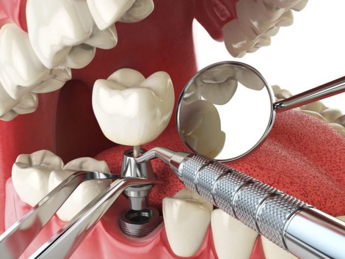 DIFFERENCES BETWEEN MINI DENTAL IMPLANTS AND REGULAR DENTAL IMPLANTS