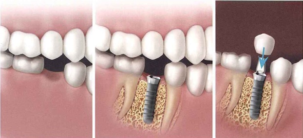 MYTHS AND FACTS ABOUT ROOT CANAL TREATMENT