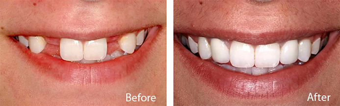 WHAT ARE TEETH IMPLANTS AND HOW CAN THEY BENEFIT PEOPLE?