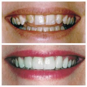 TIPS FOR BEAMING WHITE SMILE