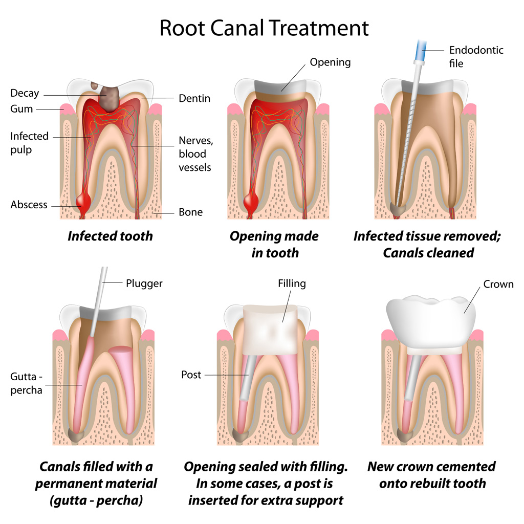 ROOT CANAL TREATMENT : A PAINLESS ELIMINATION OF TOOTH PAIN