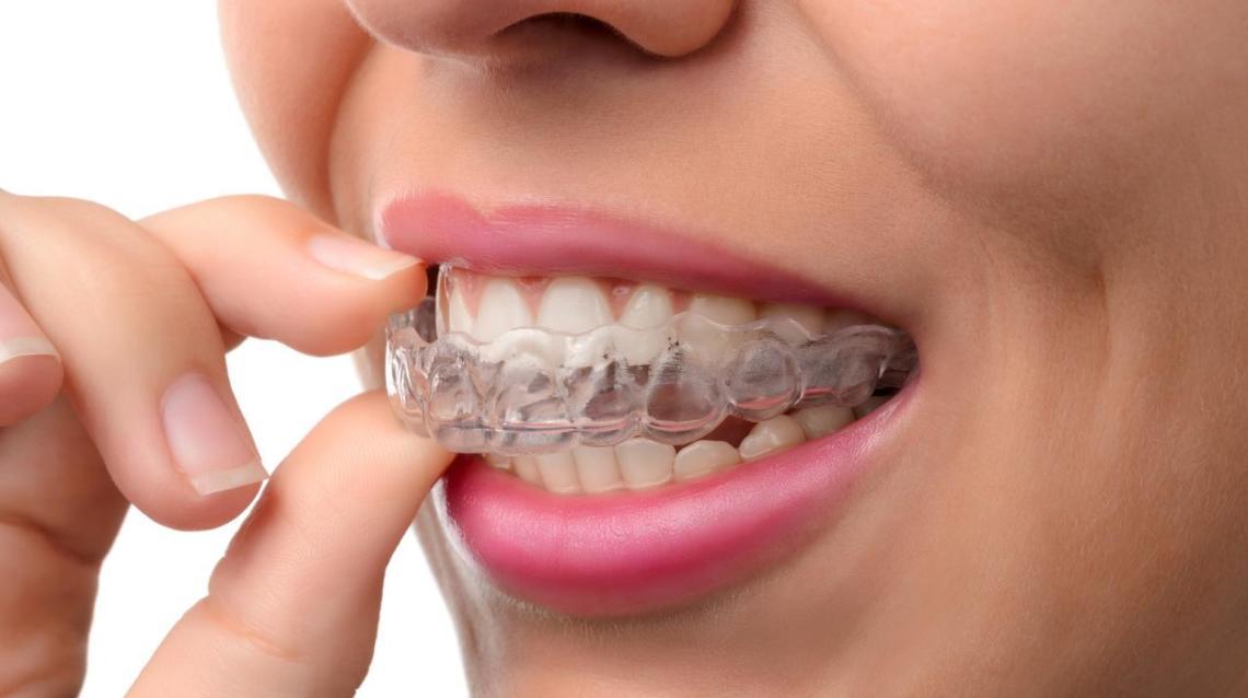FACTS ABOUT INVISIBLE BRACES