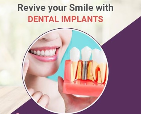 What are Dental Implants? Types & Procedures