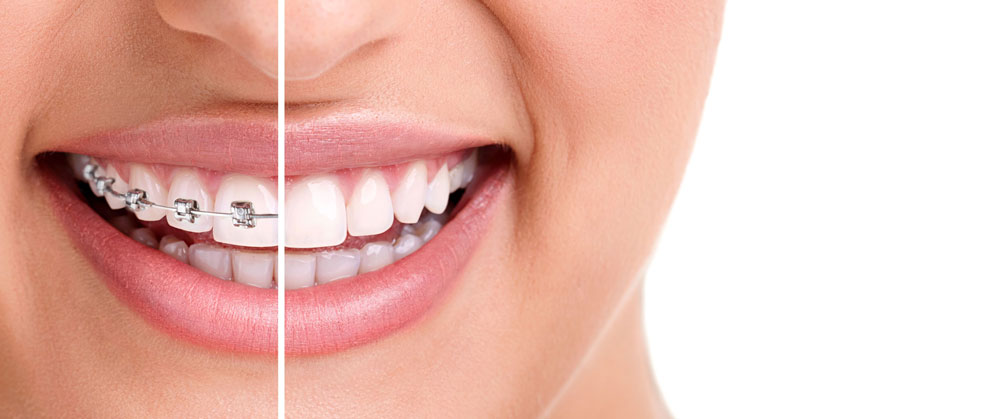 4 Dental Health Problems that can be Fixed by Orthodontic Treatment