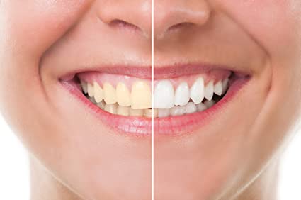 5 Best Ways to Whiten Teeth Fast