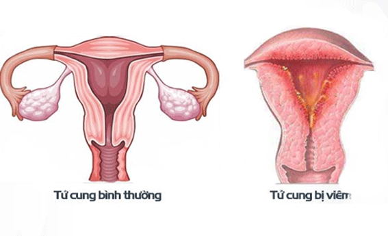 Hiện tượng rong kinh là như thế nào