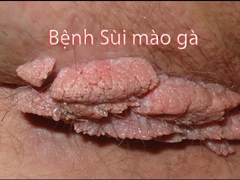 Sùi mào gà ở Da Bìu và cách chữa trị Dứt Điểm