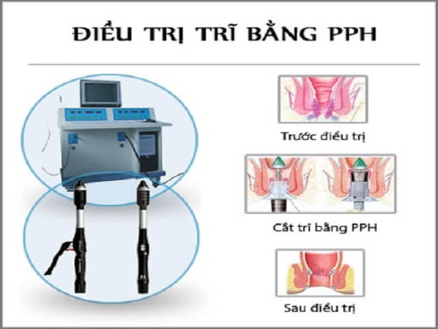 Cắt trĩ bằng phương pháp PPH bao nhiêu tiền?