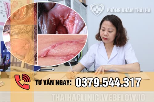 Dấu hiệu bệnh sùi mào gà ở nữ giới