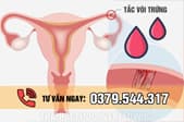 Tắc vòi trứng có rụng trứng không? Có kinh nguyệt không? Có chữa được không?