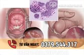 Tư vấn bệnh lậu là gì? Nguyên nhân và dấu hiệu nhận biết