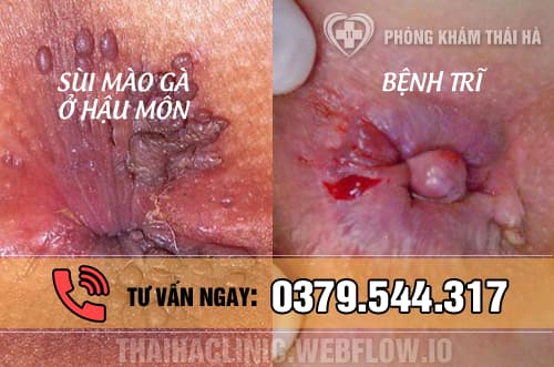 Phân biệt bệnh sùi mào gà ở hậu môn và bệnh trĩ