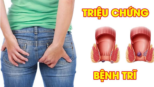Top 3 Dấu hiệu, triệu chứng bệnh trĩ thường gặp nhất