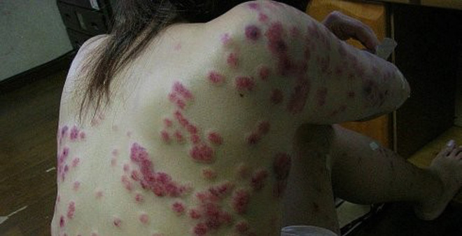 Sự nguy hiểm của giang mai với sức khỏe người bệnh
