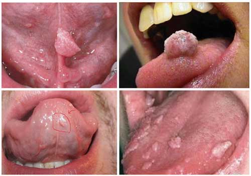 Bệnh sùi mào gà ở miệng, dấu hiệu triệu chứng và cách chữa