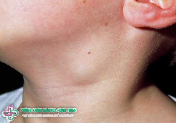 Nổi hạch ở cổ bên phải, trái là bị bệnh gì nguyên nhân do đâu?
