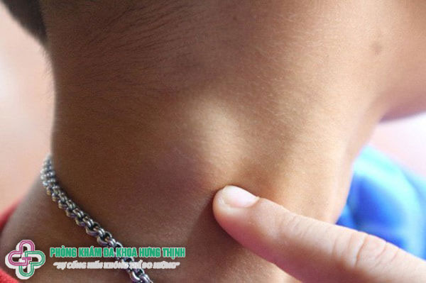 Nổi hạch ở cổ có nguy hiểm cho sức khỏe hay không?