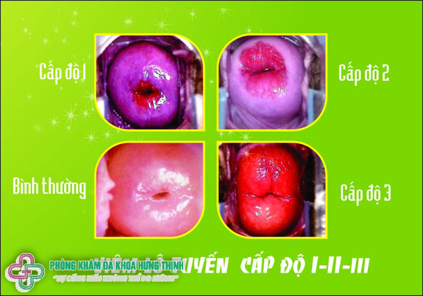 TOP 6 cách chữa viêm lộ tuyến cổ tử cung tốt nhất