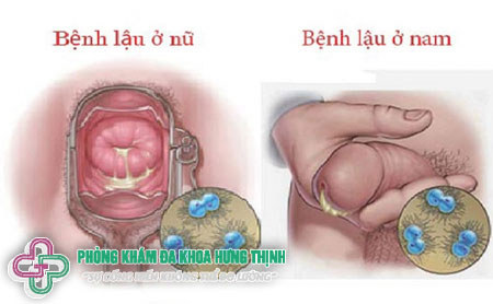 Bệnh lậu là gì?