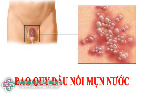 Nguyên nhân thân dương vật nổi mụn gây ngứa