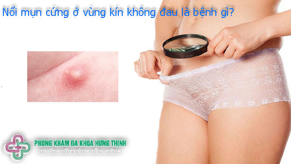Nổi mụn cứng ở vùng kín không đau là bệnh gì? Có sao không?
