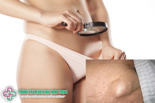 Nổi hạch ở háng là bệnh gì?