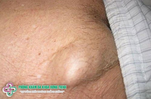 Nổi hạch ở háng do mắc bệnh xã hội