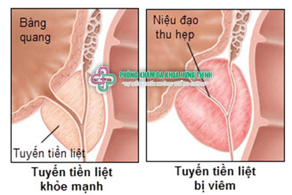 Viêm tuyến tiền liệt là gì dấu hiệu triệu chứng cách chữa trị