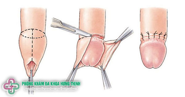 Quy trình cắt bao quy đầu an toàn tốt nhất Hà Nội hiện nay